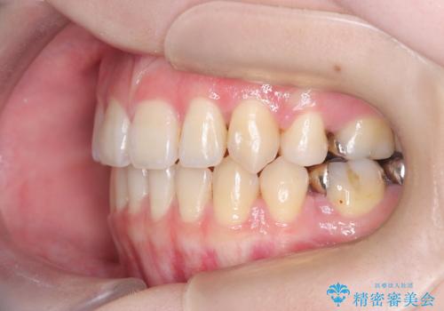 開咬・叢生(八重歯)を抜歯矯正で改善|ワイヤー矯正(クリア装置)症例の治療後