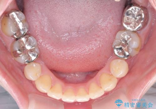 開咬・叢生(八重歯)を抜歯矯正で改善|ワイヤー矯正(クリア装置)症例の治療後
