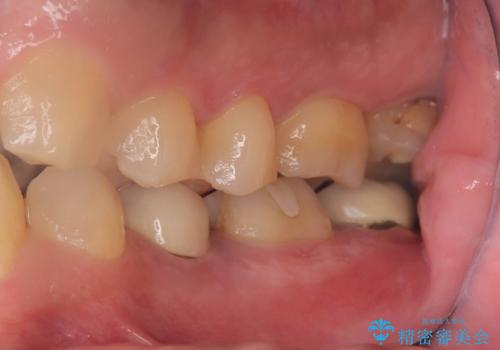 歯根嚢胞と瘻孔を伴う奥歯を抜歯即時インプラントで治療|一回の手術で改善!|インプラントの治療期間3か月の治療前
