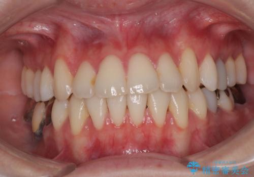 【モニター】前歯のデコボコをインビザラインで綺麗にの治療後