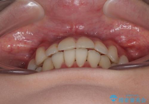 【モニター】前歯のデコボコをインビザラインで綺麗にの治療後