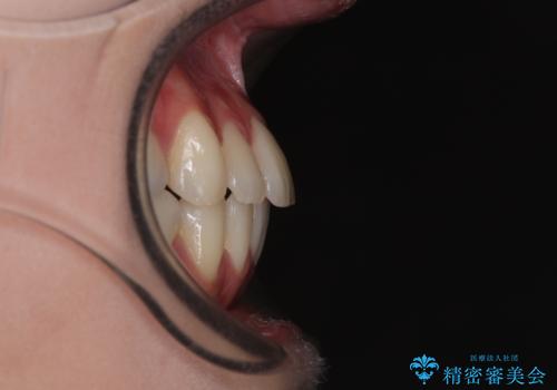 【モニター】前歯のデコボコをインビザラインで綺麗にの治療後