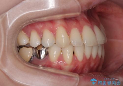 【モニター】前歯のデコボコをインビザラインで綺麗にの治療後