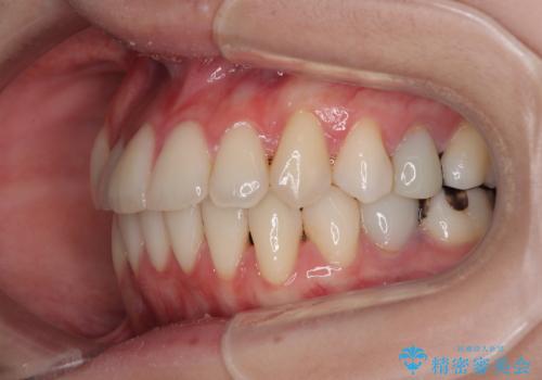 【モニター】前歯のデコボコをインビザラインで綺麗にの治療後