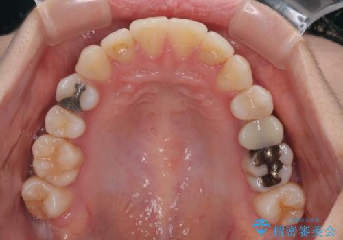 【モニター】前歯のデコボコをインビザラインで綺麗にの治療後