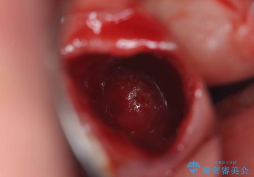 歯根嚢胞と瘻孔を伴う奥歯を抜歯即時インプラントで治療|一回の手術で改善!|インプラントの治療期間3か月の治療後