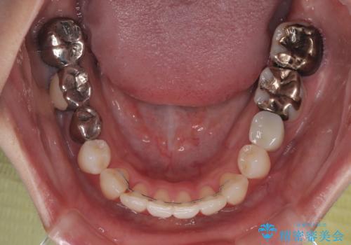 【モニター】前歯のデコボコをインビザラインで綺麗にの治療後