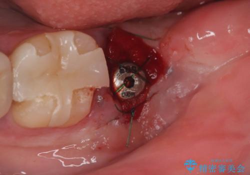 歯根嚢胞と瘻孔を伴う奥歯を抜歯即時インプラントで治療|一回の手術で改善!|インプラントの治療期間3か月の治療後