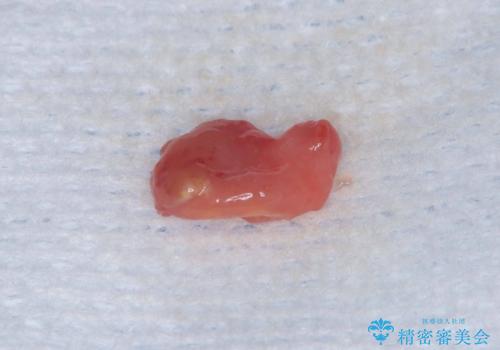 歯根嚢胞と瘻孔を伴う奥歯を抜歯即時インプラントで治療|一回の手術で改善!|インプラントの治療期間3か月の治療中