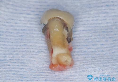 歯根嚢胞と瘻孔を伴う奥歯を抜歯即時インプラントで治療|一回の手術で改善!|インプラントの治療期間3か月の治療前