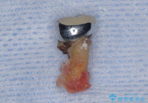 歯根嚢胞と瘻孔を伴う奥歯を抜歯即時インプラントで治療|一回の手術で改善!|インプラントの治療期間3か月の治療中
