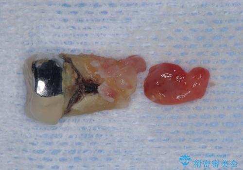 歯根嚢胞と瘻孔を伴う奥歯を抜歯即時インプラントで治療|一回の手術で改善!|インプラントの治療期間3か月の治療前