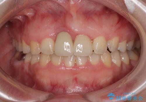 前歯のデコボコをワイヤー矯正で綺麗に 保険診療の前歯クラウンもセラミッククラウンで自然にの治療後