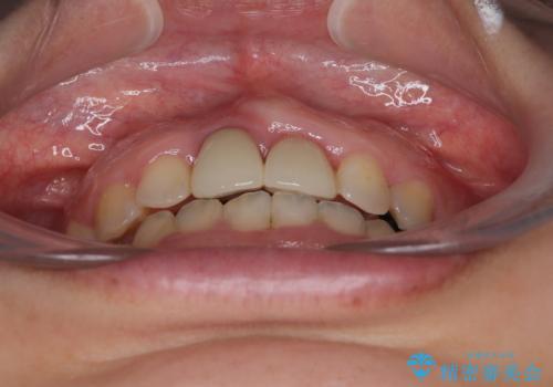 前歯のデコボコをワイヤー矯正で綺麗に　保険診療の前歯クラウンもセラミッククラウンで自然にの治療後