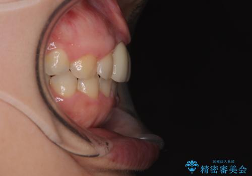 前歯のデコボコをワイヤー矯正で綺麗に 保険診療の前歯クラウンもセラミッククラウンで自然にの治療後