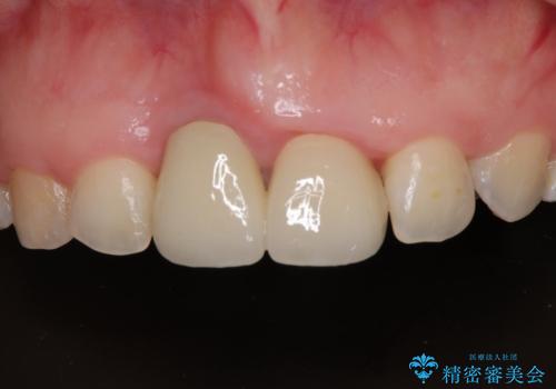 前歯のデコボコをワイヤー矯正で綺麗に　保険診療の前歯クラウンもセラミッククラウンで自然にの治療後
