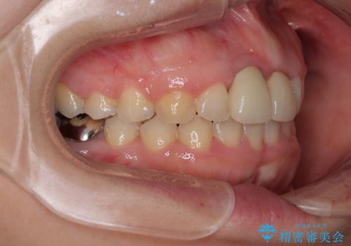 前歯のデコボコをワイヤー矯正で綺麗に　保険診療の前歯クラウンもセラミッククラウンで自然にの治療後