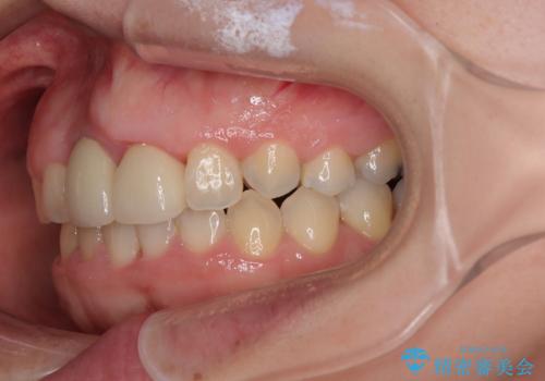 前歯のデコボコをワイヤー矯正で綺麗に 保険診療の前歯クラウンもセラミッククラウンで自然にの治療後
