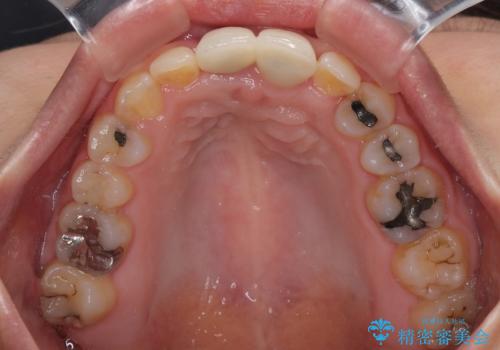 前歯のデコボコをワイヤー矯正で綺麗に 保険診療の前歯クラウンもセラミッククラウンで自然にの治療後
