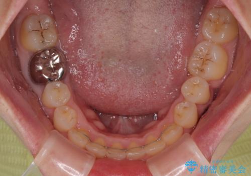 前歯のデコボコをワイヤー矯正で綺麗に 保険診療の前歯クラウンもセラミッククラウンで自然にの治療後
