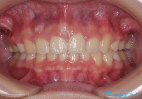 唇が閉じられない　ワイヤー装置による抜歯矯正治療の治療後