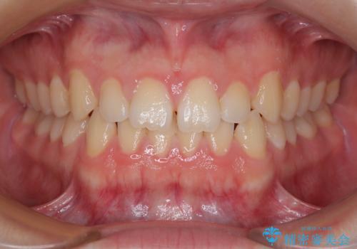 すきっ歯は放置NG?インビザラインで目立たず改善