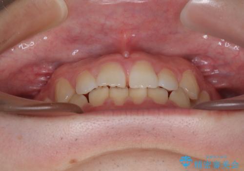 すきっ歯は放置NG?インビザラインで目立たず改善の治療前