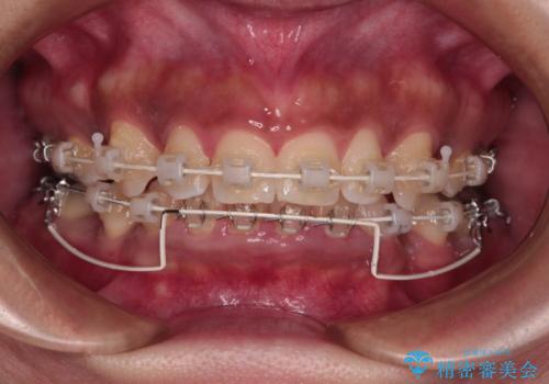 抜歯矯正で口が閉じやすく|ディープバイトと叢生を改善した症例の治療中