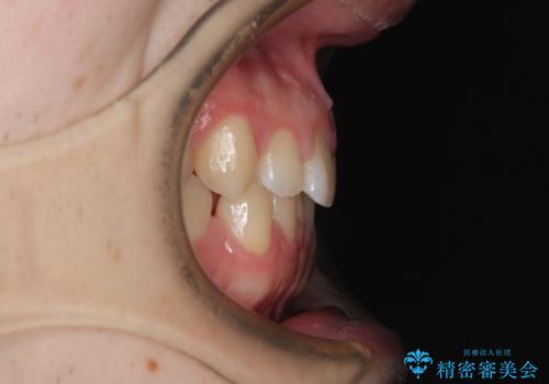 すきっ歯は放置NG?インビザラインで目立たず改善の治療前