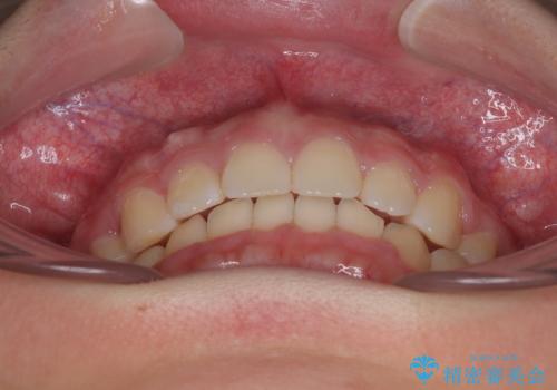 唇が閉じられない　ワイヤー装置による抜歯矯正治療の治療後