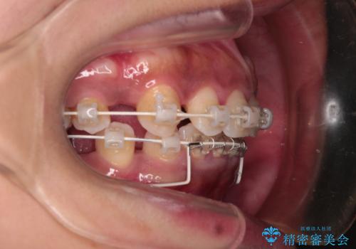 抜歯矯正で口が閉じやすく|ディープバイトと叢生を改善した症例の治療中
