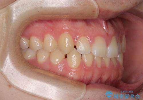 すきっ歯は放置NG?インビザラインで目立たず改善の治療前
