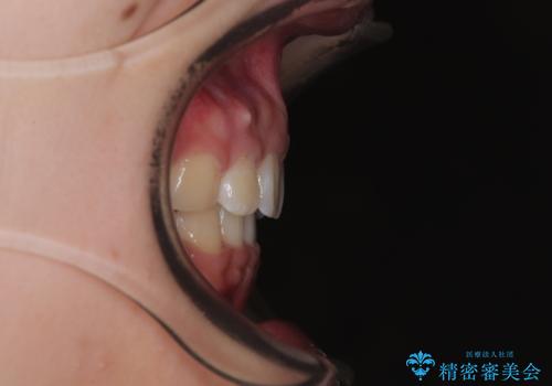 唇が閉じられない　ワイヤー装置による抜歯矯正治療の治療後