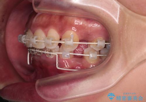 抜歯矯正で口が閉じやすく|ディープバイトと叢生を改善した症例の治療中