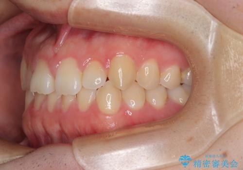 すきっ歯は放置NG?インビザラインで目立たず改善の治療前