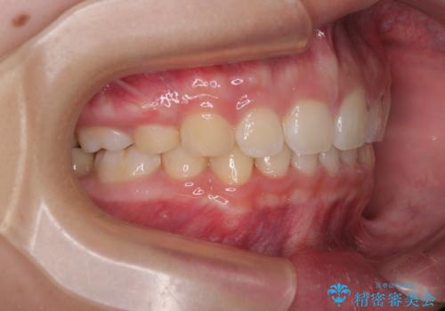 唇が閉じられない ワイヤー装置による抜歯矯正治療の治療後