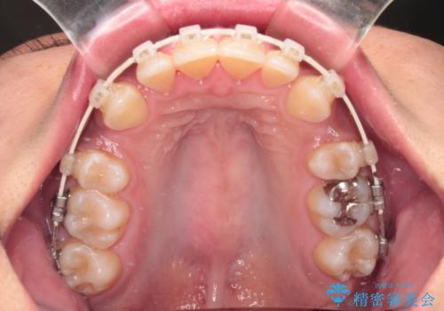 抜歯矯正で口が閉じやすく|ディープバイトと叢生を改善した症例の治療中