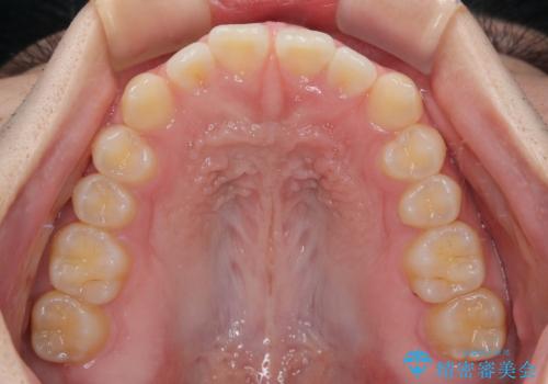 すきっ歯は放置NG?インビザラインで目立たず改善の治療前