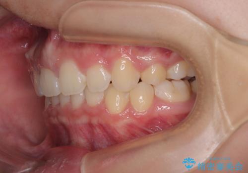 唇が閉じられない　ワイヤー装置による抜歯矯正治療の治療後