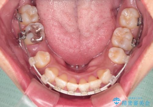 抜歯矯正で口が閉じやすく|ディープバイトと叢生を改善した症例の治療中