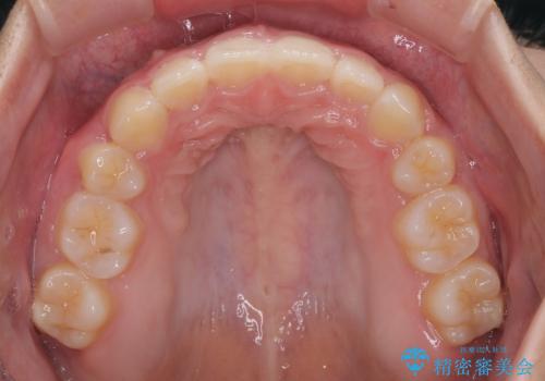 唇が閉じられない　ワイヤー装置による抜歯矯正治療の治療後