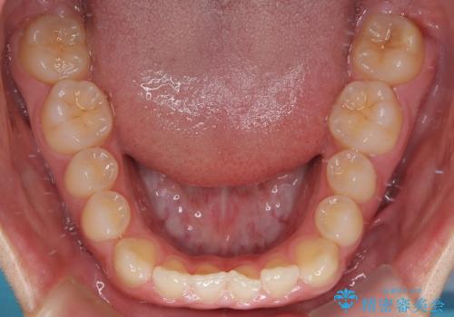 すきっ歯は放置NG?インビザラインで目立たず改善の治療前