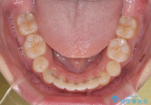 唇が閉じられない ワイヤー装置による抜歯矯正治療の治療後