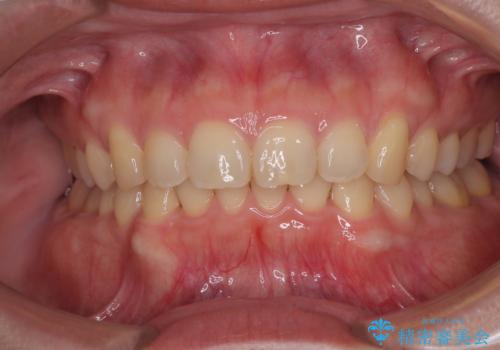 隠れた前歯が気になる　ディープバイトのワイヤー矯正治療の治療後