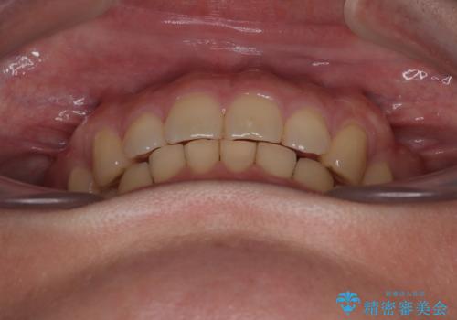 隠れた前歯が気になる ディープバイトのワイヤー矯正治療の治療後