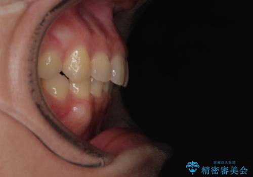 隠れた前歯が気になる　ディープバイトのワイヤー矯正治療の治療後