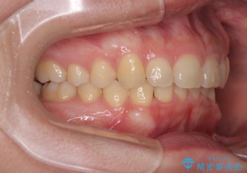 隠れた前歯が気になる　ディープバイトのワイヤー矯正治療の治療後