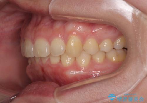 隠れた前歯が気になる　ディープバイトのワイヤー矯正治療の治療後