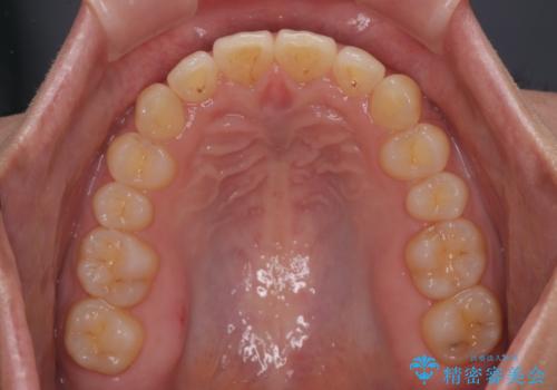 隠れた前歯が気になる　ディープバイトのワイヤー矯正治療の治療後
