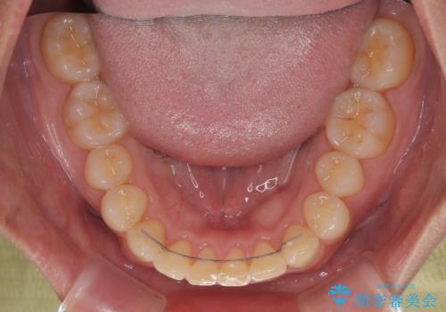 隠れた前歯が気になる ディープバイトのワイヤー矯正治療の治療後